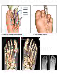 Surgical Fixation of Multiple Fracture-dislocations to Bilateral Feet
