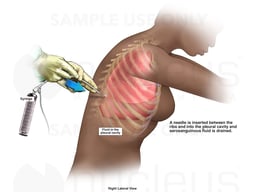 Thoracentesis