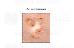 Actinic Keratosis