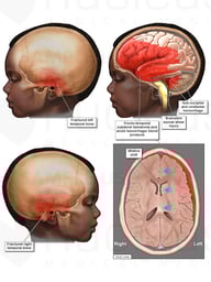 Brain and Skull Injuries