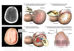Acute Left Subdural Hematoma with Surgical Decompression