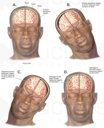 Whiplash - Mechanism of Closed Head Injury