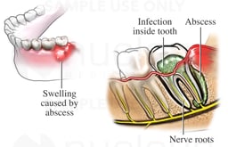 Abscessed Tooth