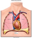 Progression of Bacterial Infection of the Pleural Fluid