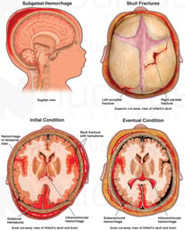 Birth Injury - Head Trauma Due to Vacuum Extraction Delivery