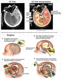 Brain Surgery - Traumatic Brain Injury with Surgical Repair