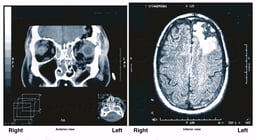 Radiological Evidence of Brain Injury