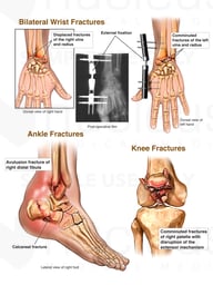 Common Auto Collision Injuries to Wrist, Knee, and Ankle
