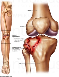 Tibial Plateau Fracture