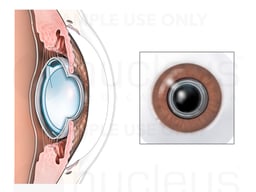 Artificial Lens