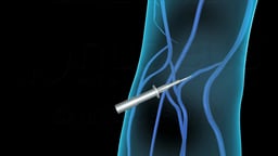 Intravenous (IV) Access in Arm