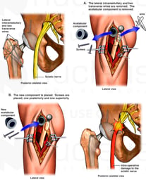 Revision of Left Hip Prosthesis with Sciatic Nerve Damage