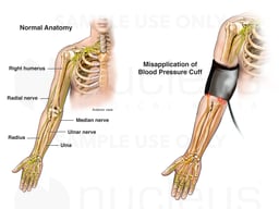 Misapplication of Blood Pressure Cuff with Nerve Damage