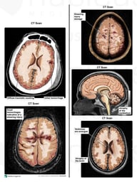 Brain Injury