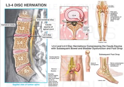 Lumbar Disc Herniations and Subsquent Nerve Damage