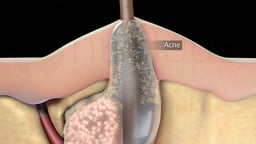 Clogged Hair Follicle Causing Acne