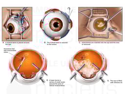 Scleral Buckle and Lensectomy