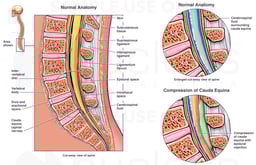 Compression of the Cauda Equina with Epidural Injection