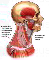 Lymph Node Biopsy with Iatrogenic Accessory Nerve (CN XI) Transection