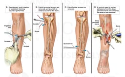 Subsequent Left Leg Surgeries