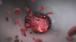 DVT (Abbreviated Version)