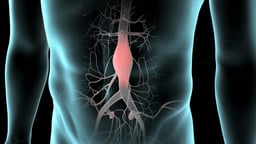 Abdominal Aortic Aneurysm within a Male Figure