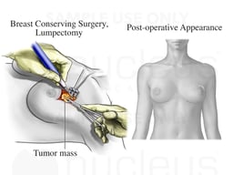 Lumpectomy