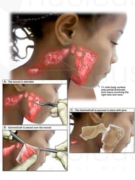 Second Degree Facial Burn with Skin Graft