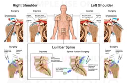 Multiple Shoulder and Lumbar Spine Injuries and Surgeries
