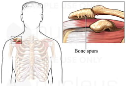 Bone Spur in the Shoulder