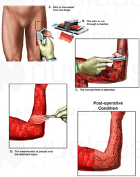Surgical Debridement and Skin Grafting