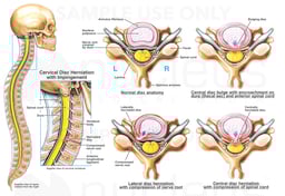 Classic Nerve Root Impingement in the Neck
