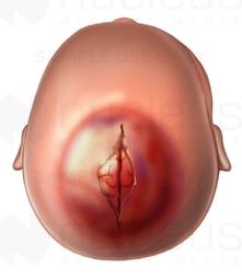 Forceps Injury to Infant Head