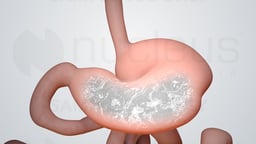 Pyloromyotomy (Pediatric)