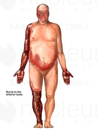 Male Figure with Post-accident Burn Injuries