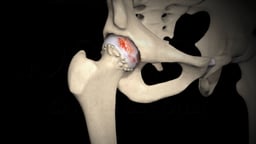 Reason for Hip Replacement