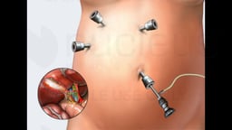 Gallbladder Removal Surgery (Laparoscopic Cholecystectomy)