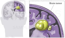 Brain Tumor