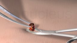 Skin Biopsy
