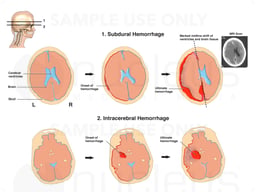 Progression of Intracranial Hemorrhages