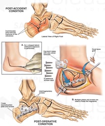 Open Fracture of the Ankle with Subsequent Surgical Fixation
