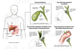 Laparoscopic Cholecystectomy with Bile Duct Injury