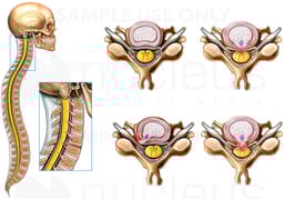 Classic Nerve Root Impingement in the Neck
