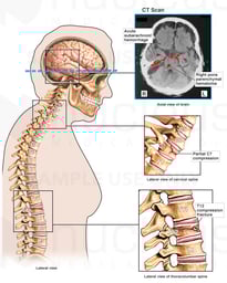 Brain and Spine Injuries