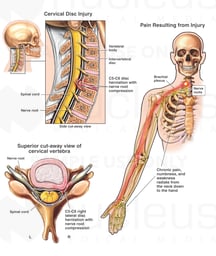 Spinal Cord - C5-6 Disc Herniation with Chronic Neurological Deficits