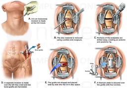 C4-5 Disc Herniation with Anterior Cervical Discectomy and Spinal Fusion Surgery