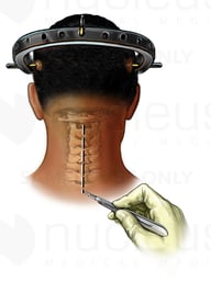 Posterior Neck Midline Incision