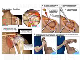 Left Shoulder Impingement Syndrome with Open Surgical Decompression