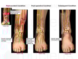 Severely Comminuted Fracture of the Lower Leg and Subsequent Condition