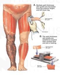 Debridement and Skin Grafting Procedure